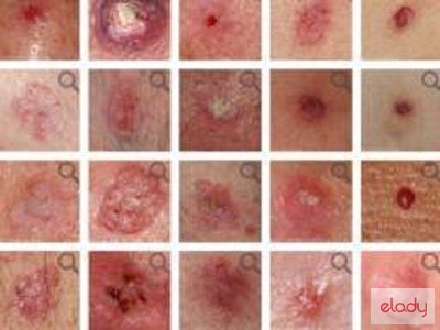 cancerul pielii